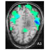 fMRI