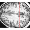 MRI