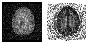 Diffusion Tensor Imaging