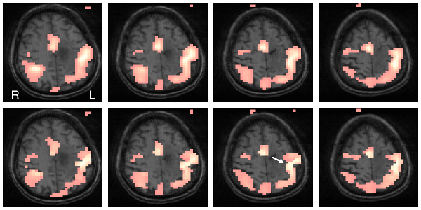 Functional Magnetic Resonance Imaging